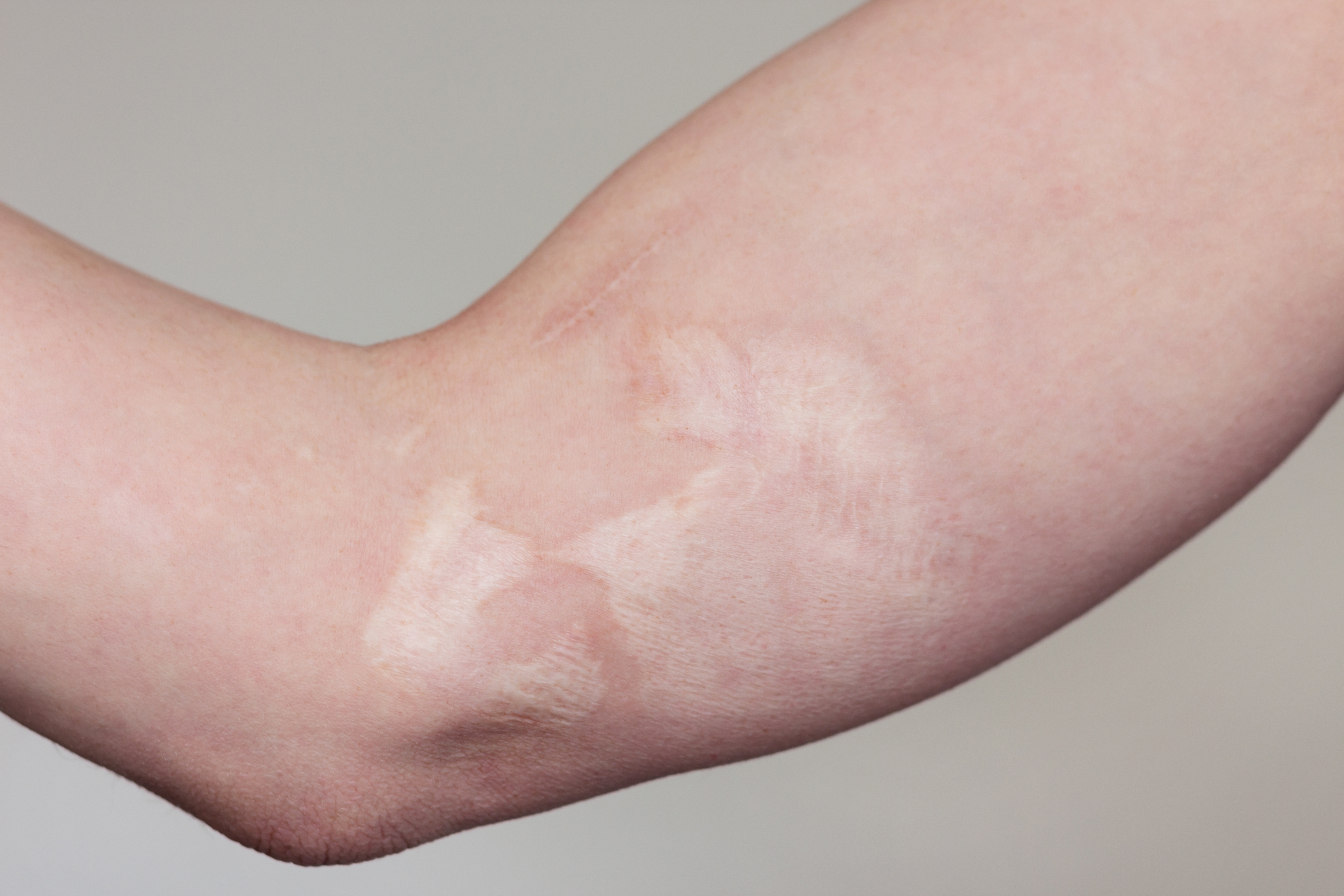 화상 흉터 재건