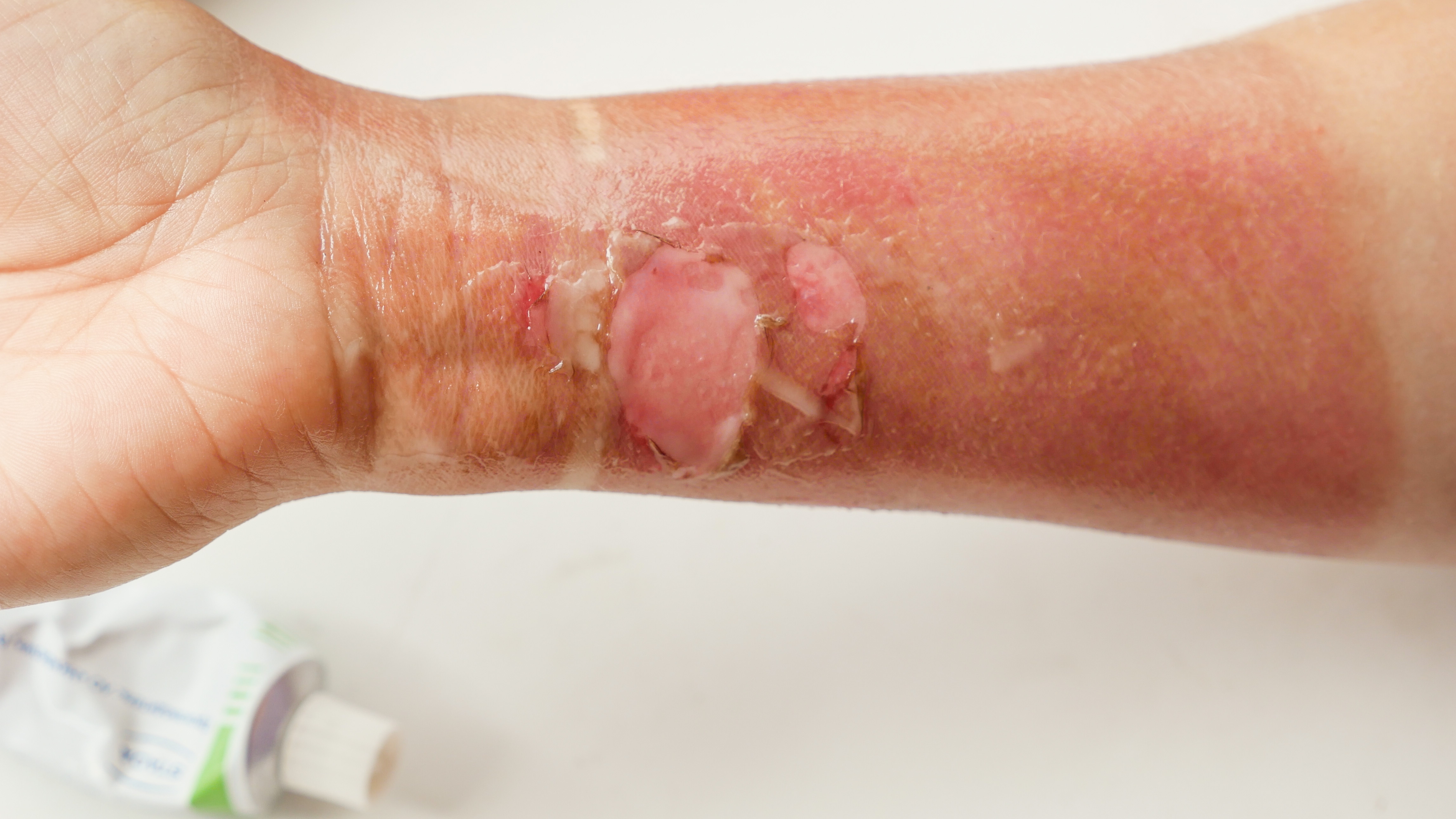 식피술 (피부이식)