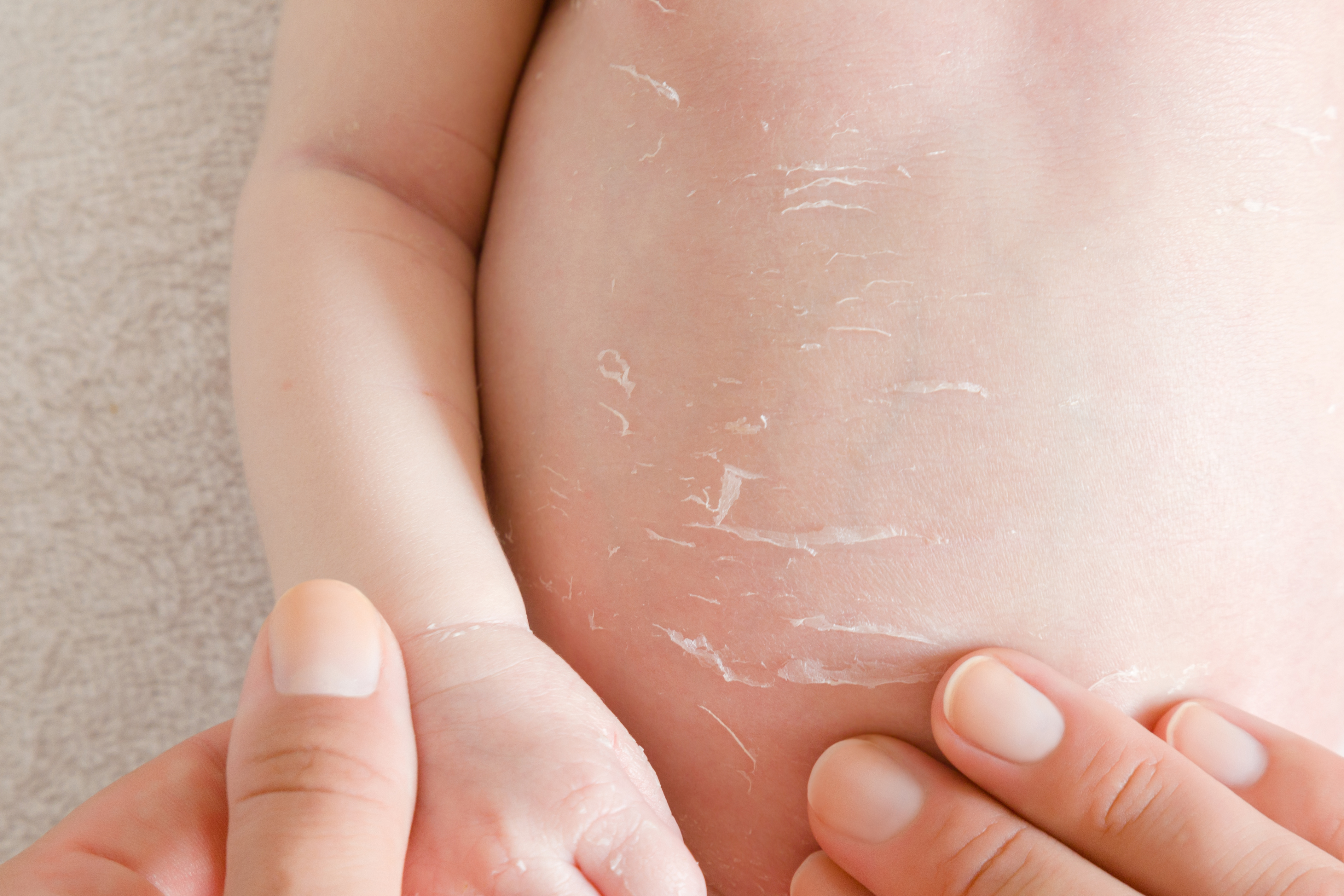 소아 화상 치료