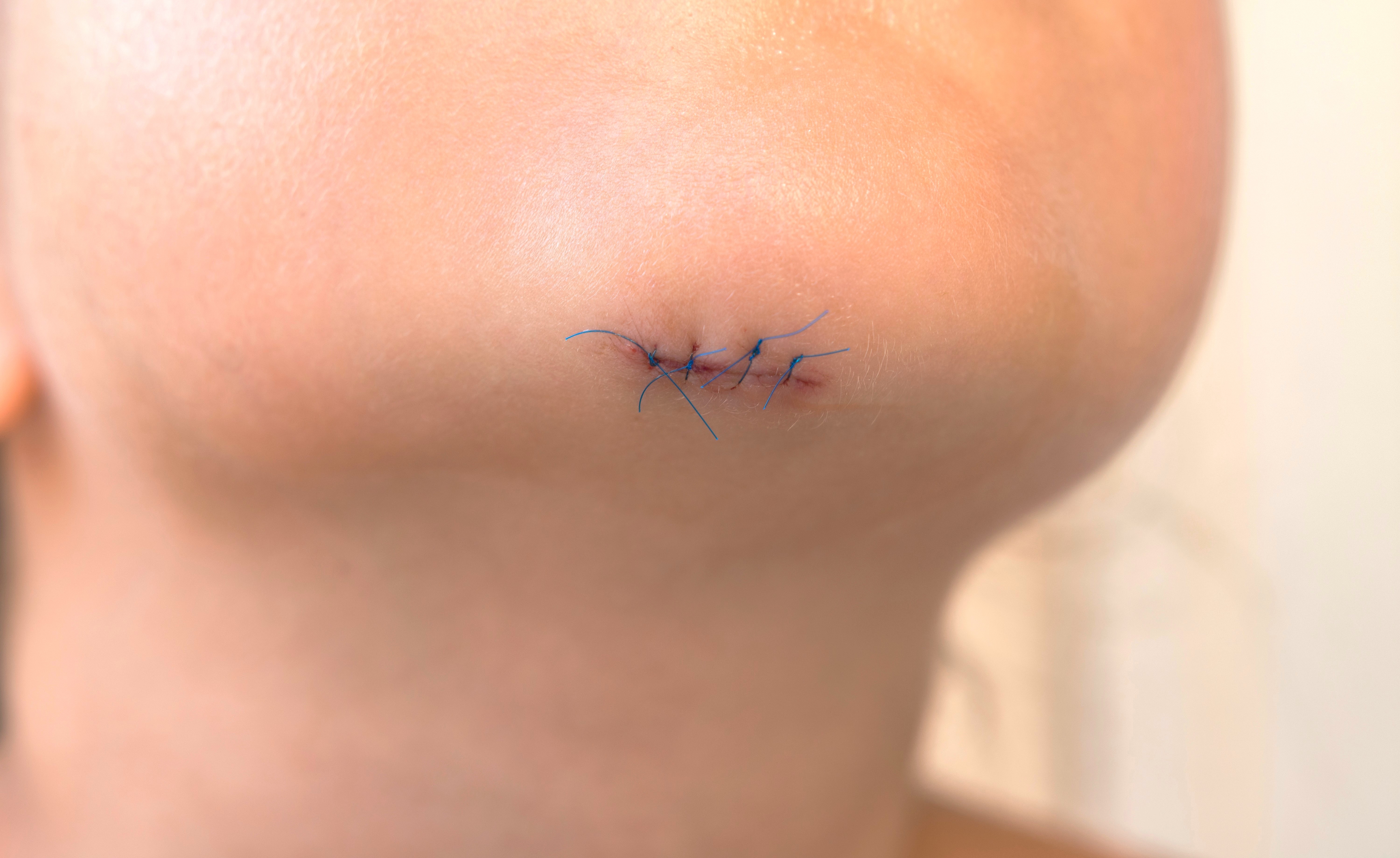 소아 열상 봉합